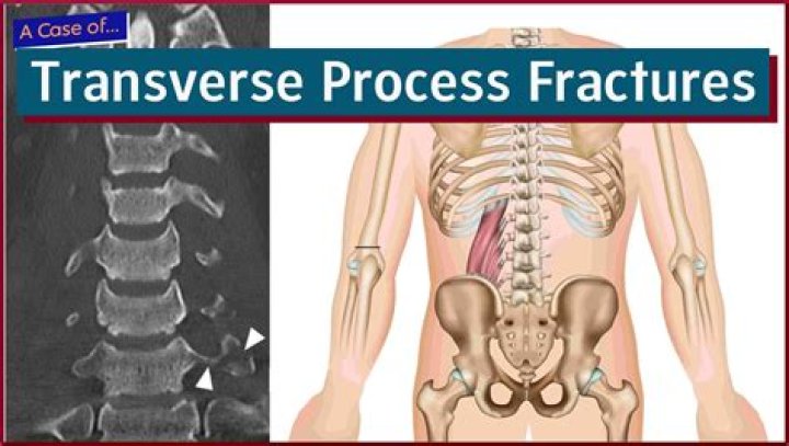 Are transverse process fractures painful