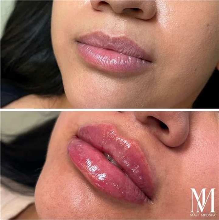 Best lip fillers near me