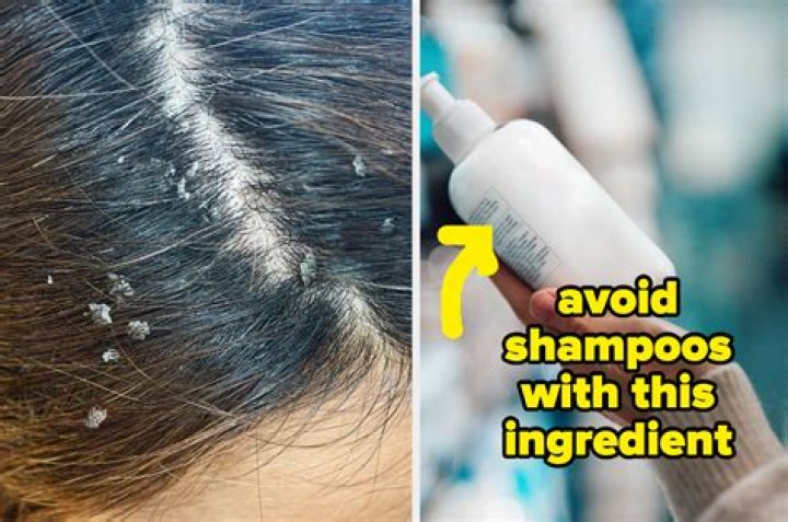 How to get rid of flaky scalp