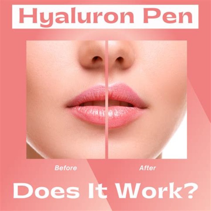 Hyaluron pen gone wrong - How To Discuss