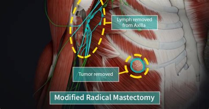 Is a lymphadenectomy painful