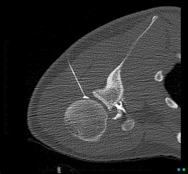 Is an arthrogram painful