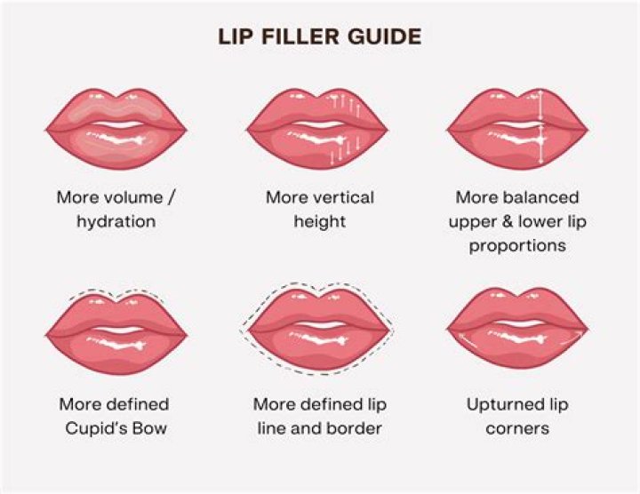 Subtle lip filler - How To Discuss