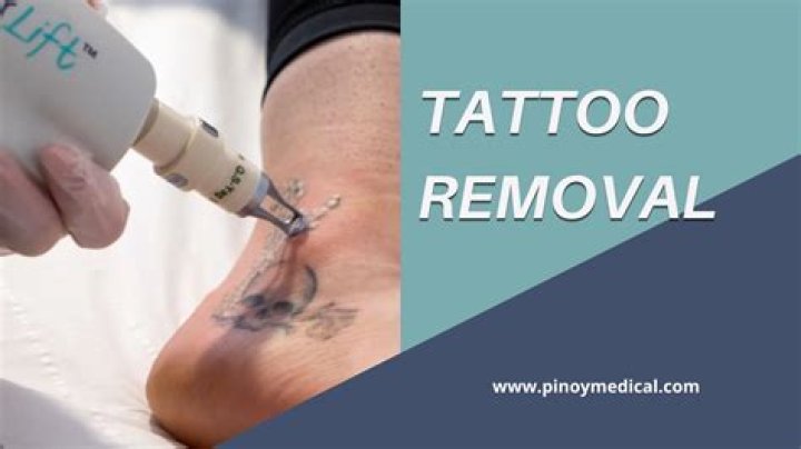 Tattoo Removal Cost - How To Discuss