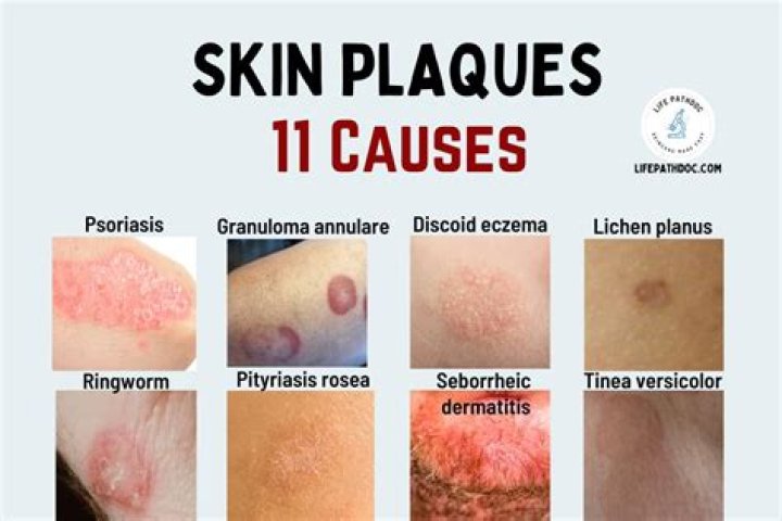 What is a plaque skin lesion