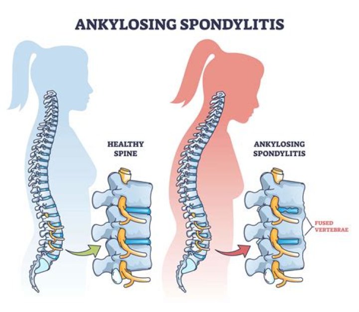 Which condition is related to ankylosing spondylitis